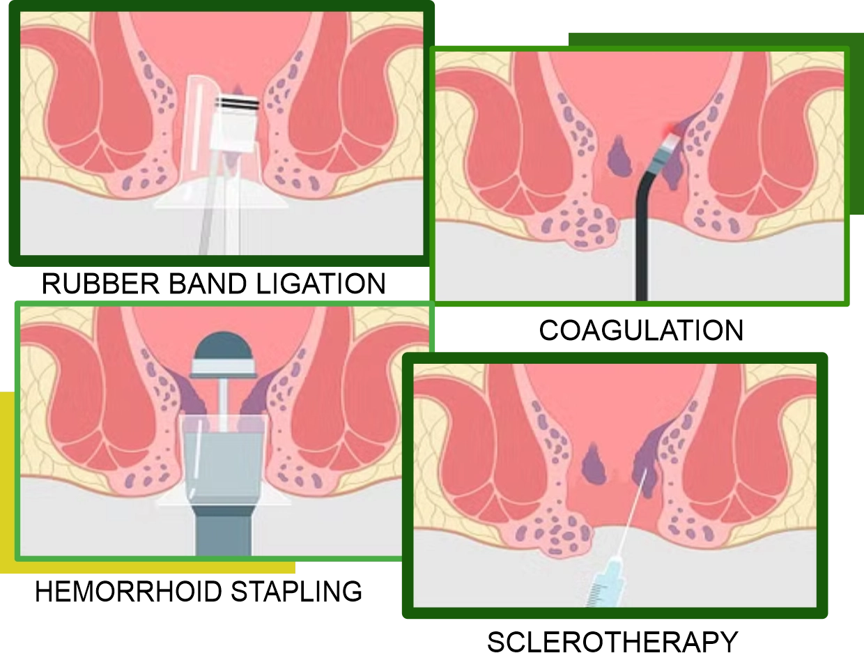 What are Piles? and Treatment of Piles?
