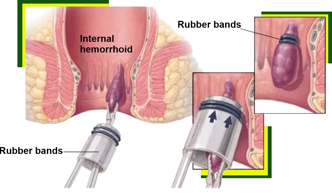 What are Piles? and Treatment of Piles?